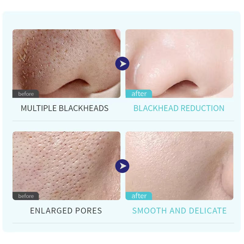 Blueidea BLD-2005 Blackhead Remover | Facial Pore Cleaner